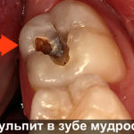 Пульпит в зубе мудрости фото