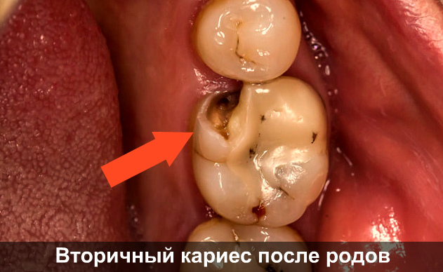 Сводит зубы после кормления