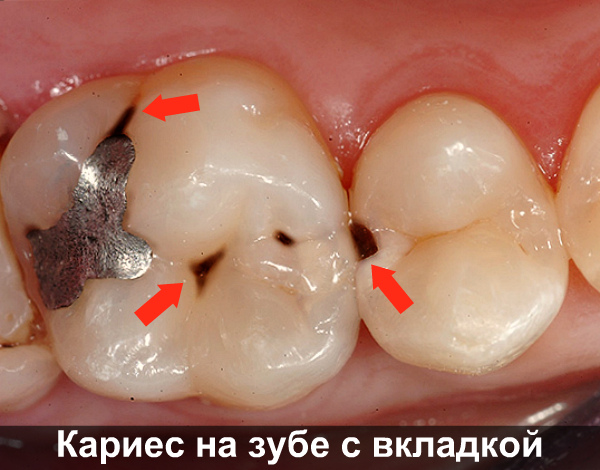 Воспаление под вкладкой зуба