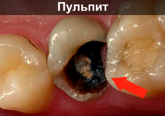 Воспаление нерва под пломбами