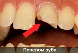 Перелом зуба фото