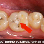 Некачественно установленная пломба
