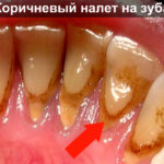 Коричневый налет на зубах фото