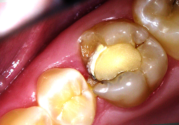 Болит зуб под пломбой