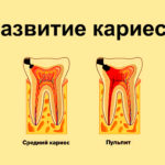 Развитие кариеса