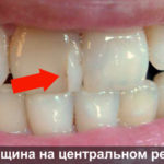 Трещины на передних зубах фото