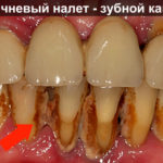 Коричневый налет - зубной камень