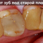 Болит зуб под старой пломбой