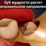 Зуб мудрости растет в неправильном направлении