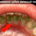 Зеленый налет на зубах фото