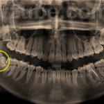 Зуб мудрости растет в зуб