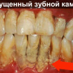 Запущенный зубной камень фото
