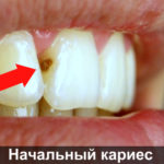 Начальный карие фото