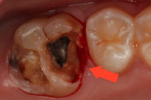Дырка в зубе фото