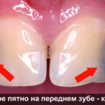 Кариес на передних зубах фото