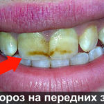 Флюороз фото