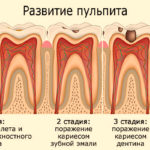 Развитие пульпита фото