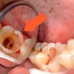 Дырка в зубе фото