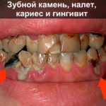 Зубной камень и гингивит