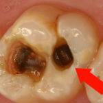 Дырка в зубе фото