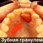 Зубная гранулема фото