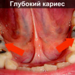 Глубокий кариес фото