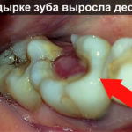 В дырке зуба выросла десна фотоВ дырке зуба выросла десна фото