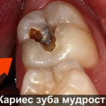 Кариес восьмерки фото
