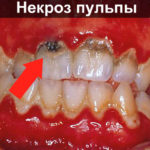 Некроз пульпы фото