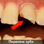 Перелом зуба фото