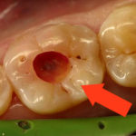 Дырка в зубе фото