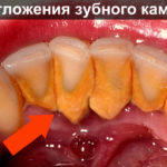 Зубной камень фото