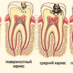 Развитие кариеса