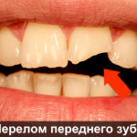 Перелом переднего зуба фото