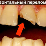 Горизонтальный перелом зуба