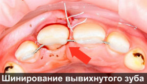 Шинирование зуба