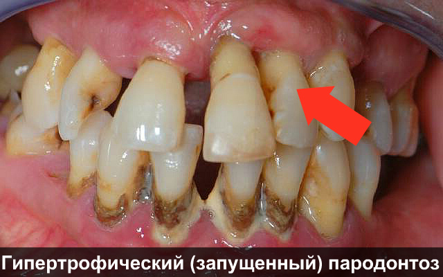 Когда болят десна чистить зубы