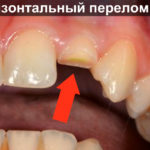 Горизонтальный перелом зуба