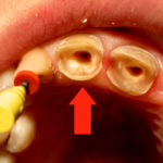 Место для установки штифта в зубе