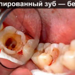 Депульпированный зуб — без нерва
