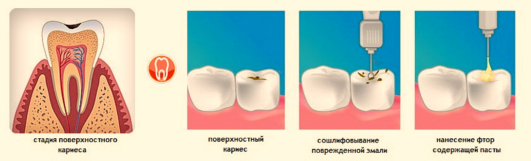 Сколько ходят с лекарством в зубе. Этапы препарирования поверхностного кариеса. Айкон пришеечный кариес. Лечение поверхностного кариеса зубов этапы. Поверхностный фиссурный кариес.