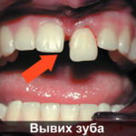 Вывих преднего зуба