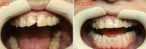 До и после наращивания зуба 