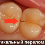Вертикальный перелом зуба