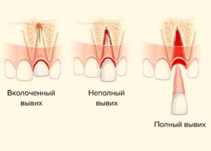 Виды вывихов зуба