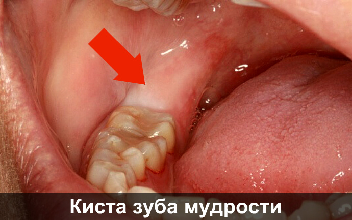 Воспаление зуба от горячего