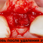 Кровь после удаления зуба