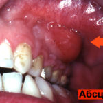 Абсцесс зуба фото
