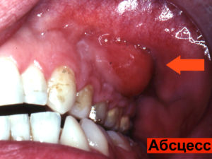 Абсцесс зуба фото