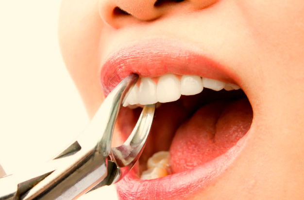 Удаление зуба может справоцировать обильное кровотечение